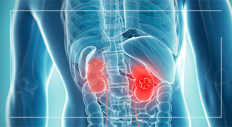 kidney-disease