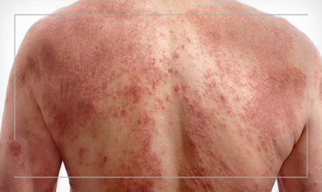 psoriasis