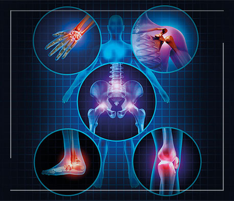 osteoarthritis