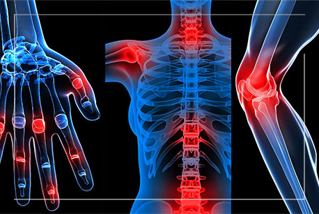 rheumatoid-arthritis