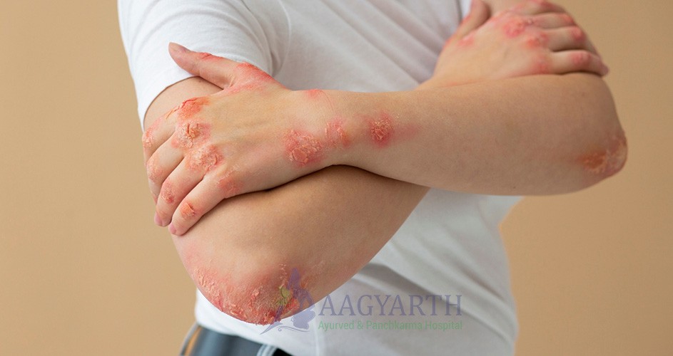 Psoriasis