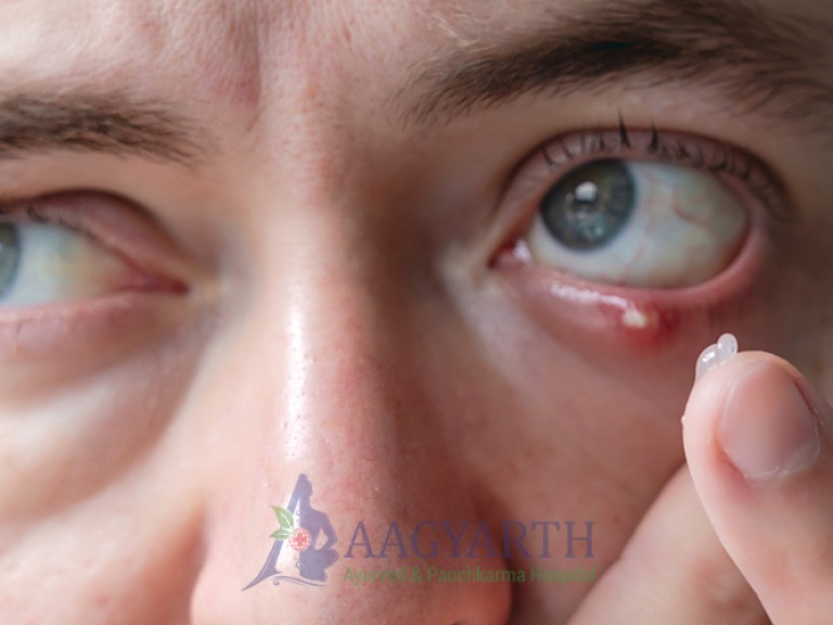 stye