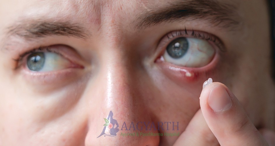 stye