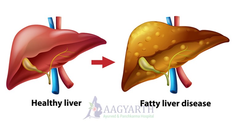 Non-Alcoholic-Fatty-Liver-Disease-(NAFLD)