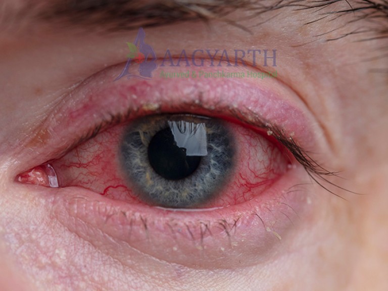 Conjuctivitis