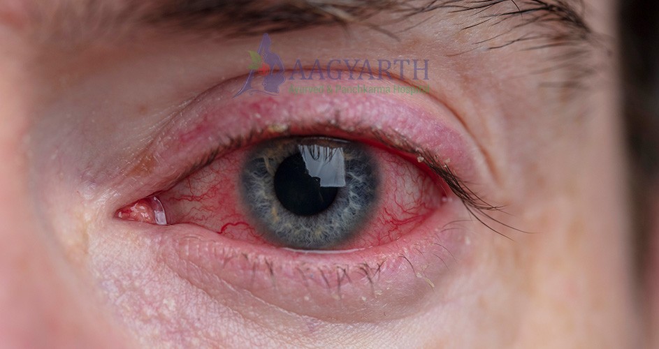 Conjuctivitis
