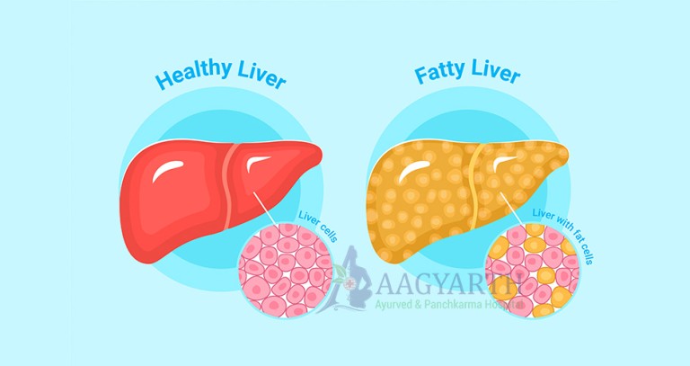 Fatty-Liver