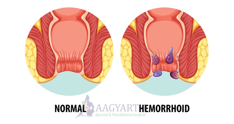 Haemorrhoids