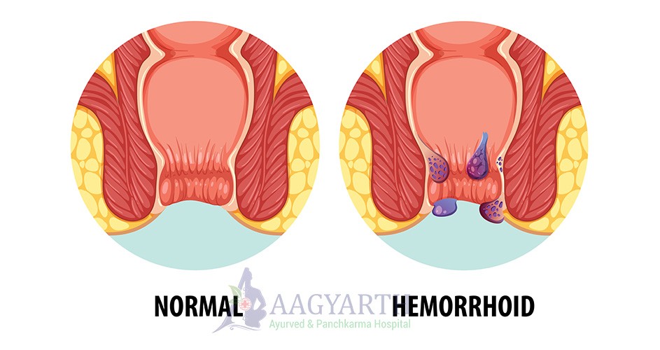 Haemorrhoids