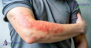 URTICARIA Ayurvedic Treatment of Lasting Relief | Ahmedabad